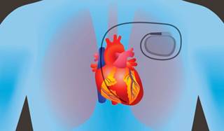 Implantable cardioverter-defibrillators are effective in young patients with symptomatic Brugada syndrome. Implantable cardioverter-defibrillators are effective in young patients with symptomatic Brugada syndrome.