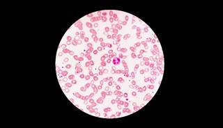 Anemia is a general risk factor for CVD. Anemia is a general risk factor for CVD.