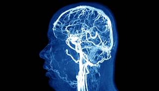 The best LDL-C cut-off value to predict stroke was 2.48 mmol/L. The best LDL-C cut-off value to predict stroke was 2.48 mmol/L.