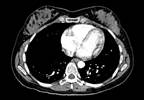 Identifying At-Risk Patients Using Coronary Artery Calcium Scores Identifying At-Risk Patients Using Coronary Artery Calcium Scores