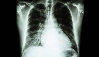 Proton pump inhibitor use is independently associated with an increased incidence of heart failure and death. Proton pump inhibitor use is independently associated with an increased incidence of heart failure and death.