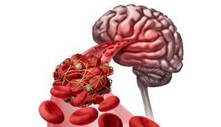 Results of the ASTER trial were presented at the International Stroke Conference. Results of the ASTER trial were presented at the International Stroke Conference.