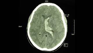 Patients at greater risk of depression had lower education levels, were <i>APOE</i> ε4 carriers, and had moderate to severe white matter disease. Patients at greater risk of depression had lower education levels, were <i>APOE</i> ε4 carriers, and had moderate to severe white matter disease.