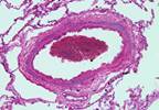 Pulmonary Arterial Hypertension and Genetics: Interview With the Experts Pulmonary Arterial Hypertension and Genetics: Interview With the Experts