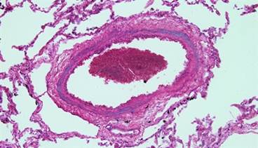 Pulmonary Arterial Hypertension and Genetics: Interview With the Experts Pulmonary Arterial Hypertension and Genetics: Interview With the Experts