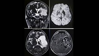 Intensive antiplatelet therapy did not reduce the risk of recurrent ischemic stroke or transient ischemic attack. Intensive antiplatelet therapy did not reduce the risk of recurrent ischemic stroke or transient ischemic attack.
