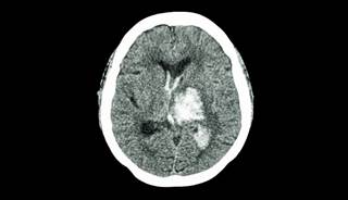 Over 80% of patients studied were not receiving appropriate anticoagulation therapy prior to their stroke. Over 80% of patients studied were not receiving appropriate anticoagulation therapy prior to their stroke.