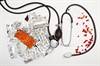 Blood Pressure Reductions With SGLT2 Inhibitors in Type 2 Diabetes Blood Pressure Reductions With SGLT2 Inhibitors in Type 2 Diabetes