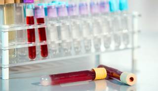 The test has been found to be more accurate than standard diagnostic methods in identifying coronary artery disease. The test has been found to be more accurate than standard diagnostic methods in identifying coronary artery disease.