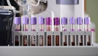 Elevated HbA1c "markedly increased" a patient's risk of experience an adverse outcome 1-year post-admission for heart failure. Elevated HbA1c "markedly increased" a patient's risk of experience an adverse outcome 1-year post-admission for heart failure.