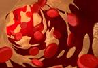 Anticoagulation Therapy May Prevent CV Events, Worsen Anemia in CKD Anticoagulation Therapy May Prevent CV Events, Worsen Anemia in CKD