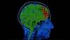 Should CHA2DS2-VASc Be Reassessed More Frequently to Improve Stroke Prevention in Afib? Should CHA2DS2-VASc Be Reassessed More Frequently to Improve Stroke Prevention in Afib?