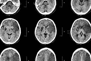 In 2010, the incidence of all strokes and of ischemic strokes was similar for men and women. In 2010, the incidence of all strokes and of ischemic strokes was similar for men and women.
