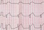 Haloperidol Associated With Slight Increased Risk for Death in Acute Myocardial Infarction Haloperidol Associated With Slight Increased Risk for Death in Acute Myocardial Infarction