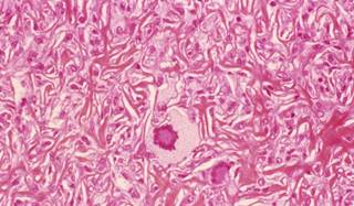 The SPIRE trials were discontinued at 14 weeks due to antidrug antibodies. The SPIRE trials were discontinued at 14 weeks due to antidrug antibodies.
