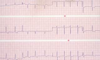 In patients with diabetes, the risk for atrial fibrillation development is higher in women vs men. In patients with diabetes, the risk for atrial fibrillation development is higher in women vs men.