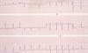 Atrial Fibrillation With Diabetes: Risk for Cardiovascular Events in Women vs Men Atrial Fibrillation With Diabetes: Risk for Cardiovascular Events in Women vs Men