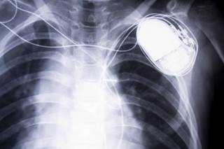 Risk of infective endocarditis twice as high in patients with a pacemaker undergoing aortic valve replacement. Risk of infective endocarditis twice as high in patients with a pacemaker undergoing aortic valve replacement.