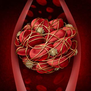 VTE is more common among dialysis patients than in the general population, and the risk is highest in the first 6 months after dialysis initiation. VTE is more common among dialysis patients than in the general population, and the risk is highest in the first 6 months after dialysis initiation.