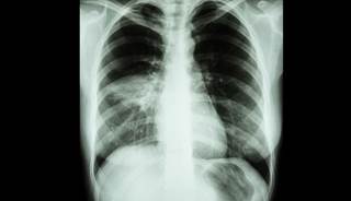 Researchers attributed cardiac mortality in community-acquired pneumonia to elevated cardiac troponin (cTnT) levels. Researchers attributed cardiac mortality in community-acquired pneumonia to elevated cardiac troponin (cTnT) levels.