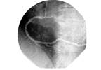 Exercise Time After Percutaneous Coronary Intervention for Angina Exercise Time After Percutaneous Coronary Intervention for Angina
