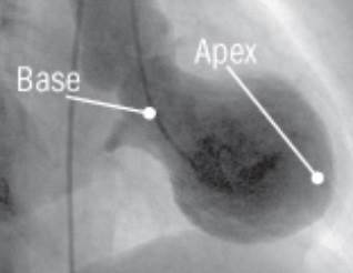 July, August, and September are the months with the highest number of Takotsubo cardiomyopathy admissions. <i> Photo credit: D. Douglas Miller, MD </i> July, August, and September are the months with the highest number of Takotsubo cardiomyopathy admissions. <i> Photo credit: D. Douglas Miller, MD </i>