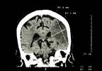 Case Study: Adverse Cerebrovascular Event With Testosterone Use Case Study: Adverse Cerebrovascular Event With Testosterone Use