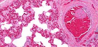 Thrombolytic therapy did not affect long-term mortality rates or reduce right ventricular dysfunction in patients after intermediate-risk pulmonary embolism. Thrombolytic therapy did not affect long-term mortality rates or reduce right ventricular dysfunction in patients after intermediate-risk pulmonary embolism.