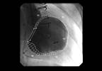 Patient With Heart Failure Coughs Up Bronchial Tree-Shaped Blood Clot Patient With Heart Failure Coughs Up Bronchial Tree-Shaped Blood Clot