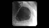 Patient With Heart Failure Coughs Up Bronchial Tree-Shaped Blood Clot Patient With Heart Failure Coughs Up Bronchial Tree-Shaped Blood Clot