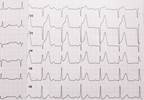 Increased CVD Risk With ECG Abnormalities in Type 1 Diabetes Increased CVD Risk With ECG Abnormalities in Type 1 Diabetes