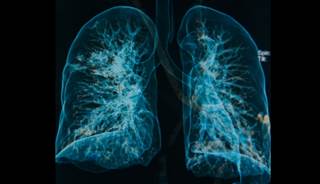 Pneumonia risk was decreased with cholinesterase inhibitors and histamine receptor-2 antagonists. Pneumonia risk was decreased with cholinesterase inhibitors and histamine receptor-2 antagonists.