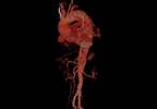 Aortic Stiffness, Concentric LV Remodeling Linked in T2DM Aortic Stiffness, Concentric LV Remodeling Linked in T2DM