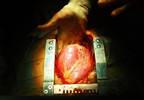 Post-Cardiac Transplantation Empagliflozin Use Associated With Metabolic Benefits in T2D Post-Cardiac Transplantation Empagliflozin Use Associated With Metabolic Benefits in T2D