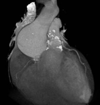 Researchers used CT angiography to examine the coronary atherosclerotic burden in <i>ANGPTL3</i> deficiency. Researchers used CT angiography to examine the coronary atherosclerotic burden in <i>ANGPTL3</i> deficiency.