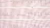 Obesity Paradox Reported for CVD Death Outcomes in Atrial Fibrillation Obesity Paradox Reported for CVD Death Outcomes in Atrial Fibrillation