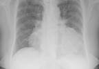Low Hip BMD Associated With Higher HF Risk in Certain Patient Subgroups Low Hip BMD Associated With Higher HF Risk in Certain Patient Subgroups