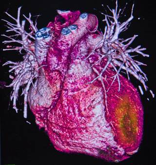 The risk for developing hypertension and/or experiencing myocardial infarction, stroke, heart failure, or angina was similar whether or not a participant had begun the study deficient in vitamin D. The risk for developing hypertension and/or experiencing myocardial infarction, stroke, heart failure, or angina was similar whether or not a participant had begun the study deficient in vitamin D.