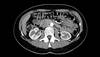 Does Prophylactic Hydration Actually Prevent Contrast-Induced Nephropathy? Does Prophylactic Hydration Actually Prevent Contrast-Induced Nephropathy?