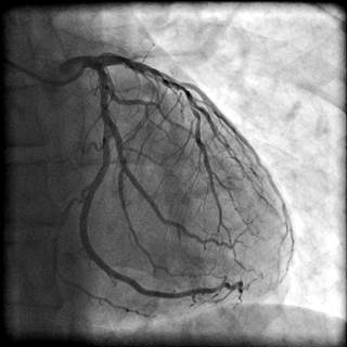 Hair whitening score, hypertension, and dyslipidemia were all independent predictors of atherosclerotic coronary artery disease. Hair whitening score, hypertension, and dyslipidemia were all independent predictors of atherosclerotic coronary artery disease.