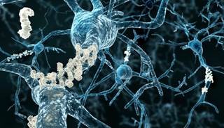 Amyloid deposits were noted in the brains of seniors with obesity, diabetes, and estimated cholesterol. Amyloid deposits were noted in the brains of seniors with obesity, diabetes, and estimated cholesterol.