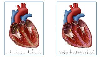 Surgical ablation is recommended in certain patients with atrial fibrillation. Surgical ablation is recommended in certain patients with atrial fibrillation.