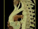 PAH-Associated Congenital Heart Disease Outcomes Predicted by Pulmonary Artery Compliance PAH-Associated Congenital Heart Disease Outcomes Predicted by Pulmonary Artery Compliance