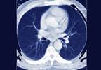 Early CVD Detection in Patients With RA: Expert Insight Early CVD Detection in Patients With RA: Expert Insight