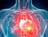 Risk for Heart Attack and Stroke Increases With Psychological Distress Risk for Heart Attack and Stroke Increases With Psychological Distress