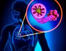 Sputum Microbiome May Predict Prognosis After COPD Hospitalization Sputum Microbiome May Predict Prognosis After COPD Hospitalization
