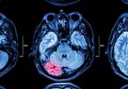 Improving Stroke Diagnosis Accuracy: An Expert Interview Improving Stroke Diagnosis Accuracy: An Expert Interview