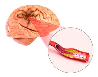 PFO closure prevents recurrent stroke relative to antiplatelet therapy, but possibly not relative to anticoagulant therapy. PFO closure prevents recurrent stroke relative to antiplatelet therapy, but possibly not relative to anticoagulant therapy.