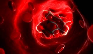 LAA isolation was achieved after a mean of 2 procedures. LAA isolation was achieved after a mean of 2 procedures.