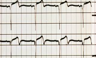 Rivaroxaban reduced risk of acute MI admission, but only in men. Rivaroxaban reduced risk of acute MI admission, but only in men.